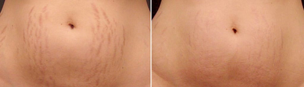 Brazilian Stretch Mark Camouflage before and after