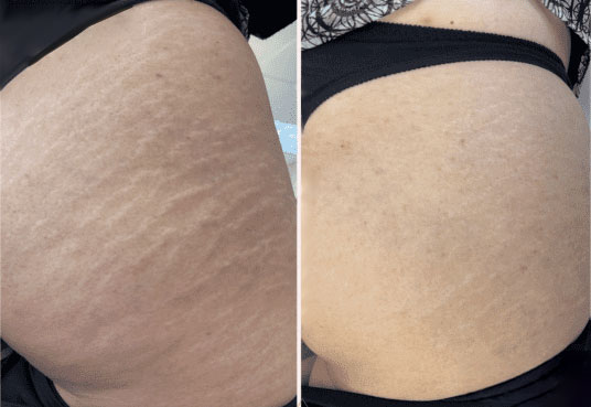brazilian stretch mark treatment