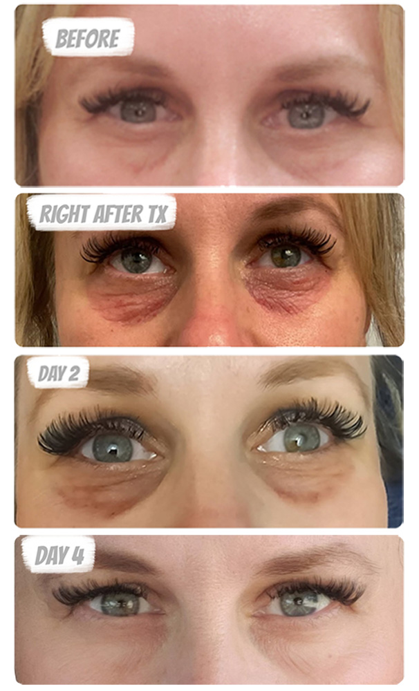 brazilian camouflage undereye lightening progress